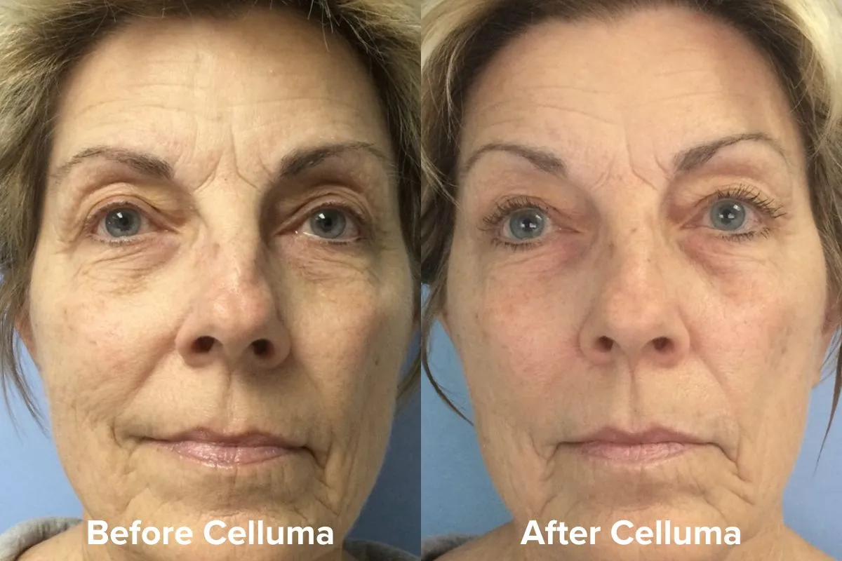 Celluma PRO